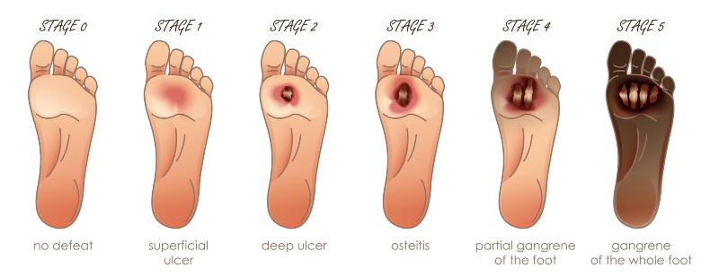 Stages of Diabetic Foot Ulcer at Southern Delaware Foot Ankle