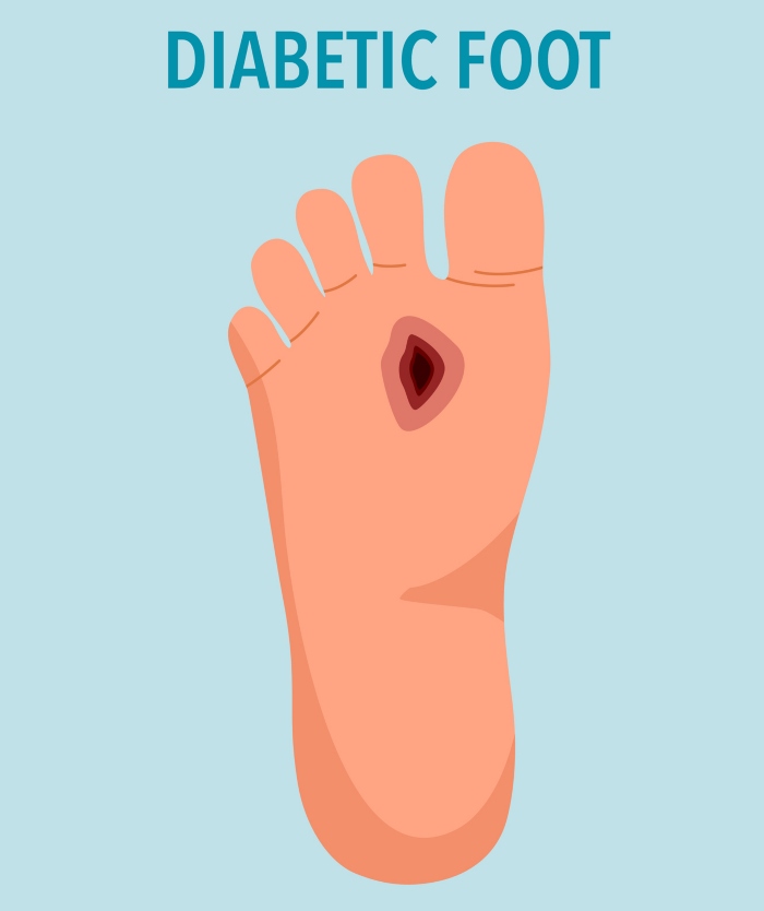 Diabetic Foot Treatment at Southern Delaware foot & Ankle
