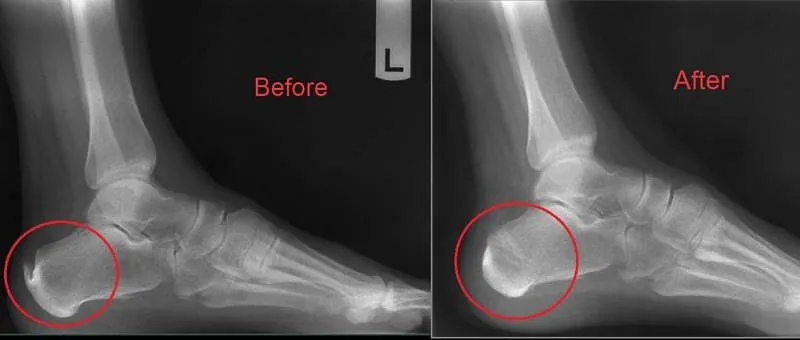 An x-ray showing the before and after results of Heel Pain treatment in Millsboro & Seaford, DE