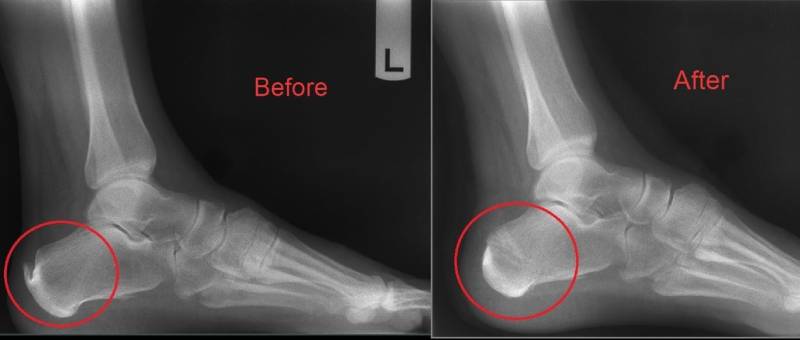 Heel Spur Xray Before & After Treatment Images - Southern Delaware Foot & Ankle
