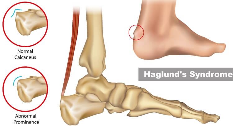 Haglund's Deformity Treatment - Southern Delaware Foot & Ankle