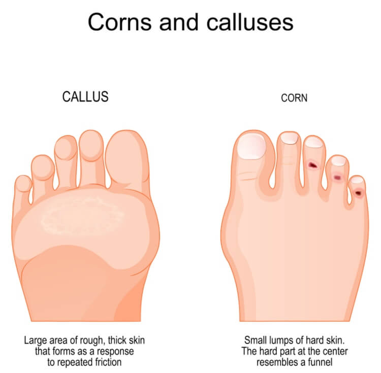 Difference Between Corns Vs. Calluses