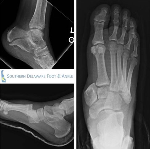 X-ray image of a foot and ankle, showcasing bones and structure, Millsboro, DE
