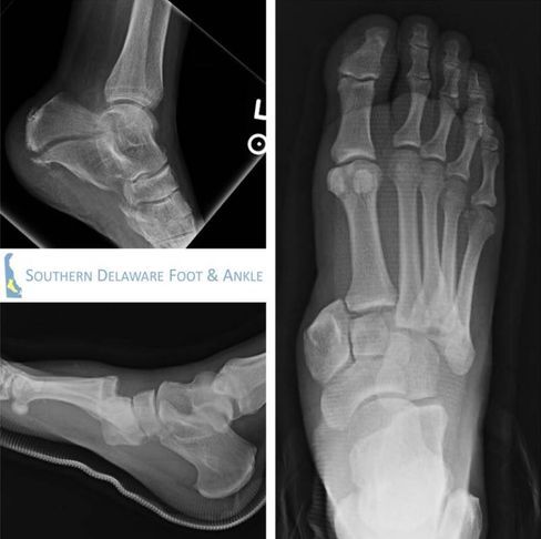 Foot X-Ray at Southern Delaware Foot & Ankle