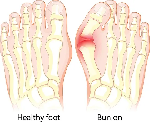 Difference between Bunion and Healthy Foot in Millsboro & Seaford, DE 