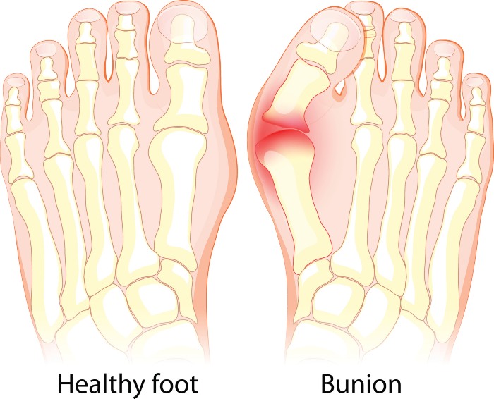 Difference between Bunion and Healthy Foot in Millsboro & Seaford, DE 