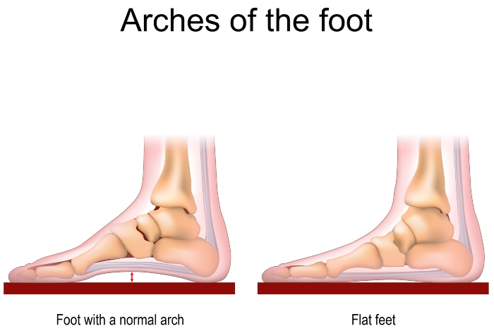 Difference Between Foot Normal arch & Flat Feet