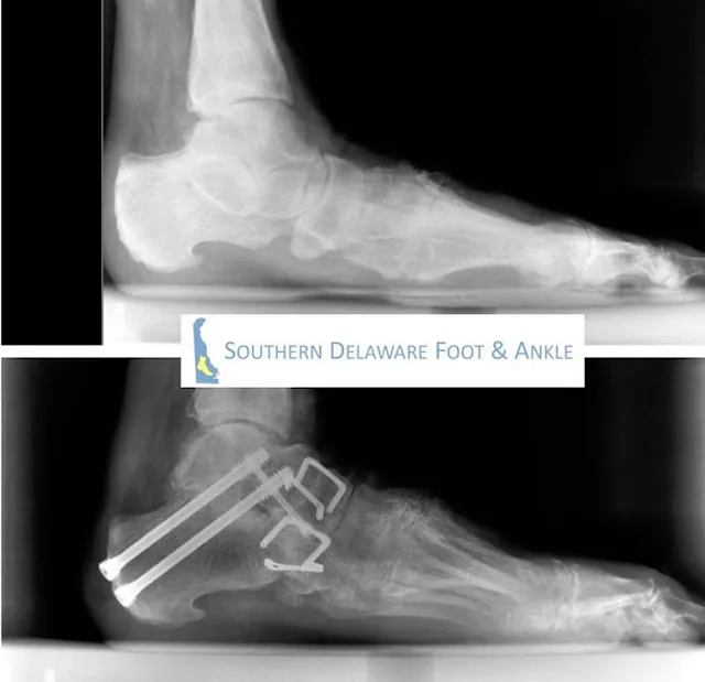 X-ray of a person showing the treatment effects of flatfoot treatment in Millsboro & Seaford, DE