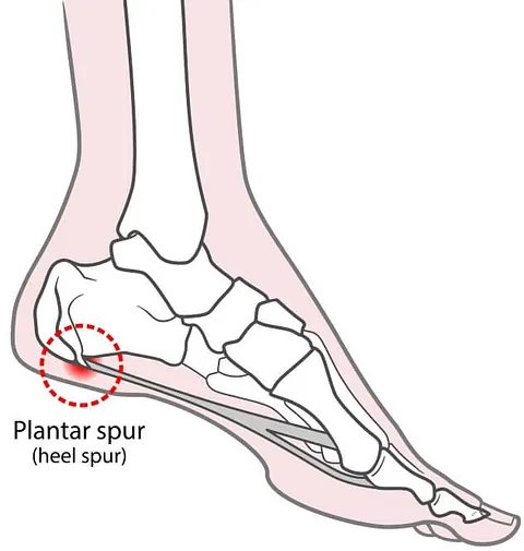 Illustration of foot spurs, depicting symptoms of Plantar Fasciitis treatment in Seaford, DE