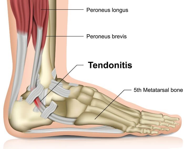 An illustration in Millsboro and Seaford, DE, explaining where the tendonitis occurs.