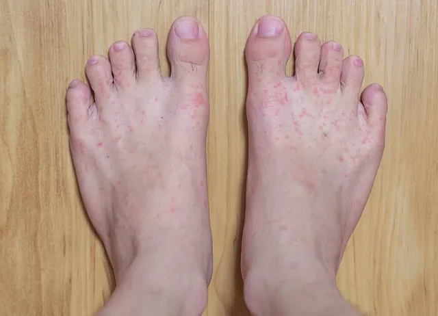 Close-up view of a foot showing signs of infection like redness, swelling, and itchiness