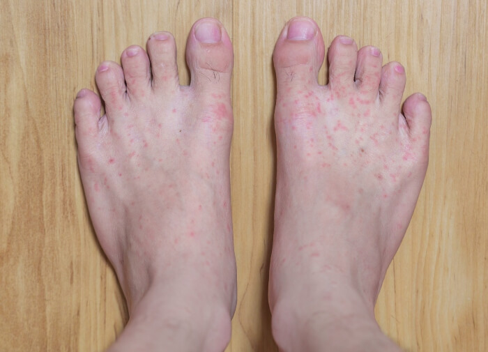 Foot Infection with Redness, swelling and Itchiness